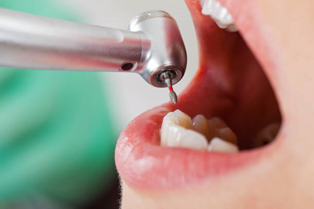 Best Emergency Tooth Extraction in Wonder Lake, IL